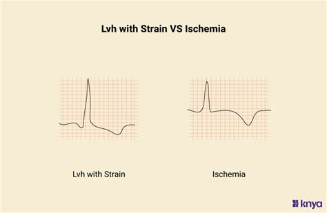 lv weed strain|lvh strain pattern vs ischemia.